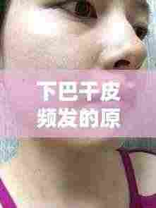 下巴干皮频发的原因、对策及日常护理之道