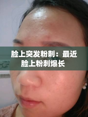 脸上突发粉刺：最近脸上粉刺爆长 