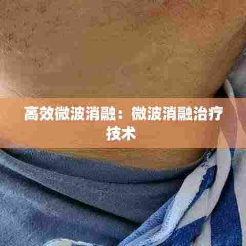 高效微波消融：微波消融治疗技术 