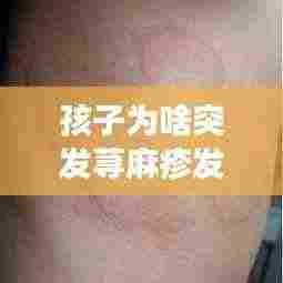 孩子为啥突发荨麻疹发烧：小孩荨麻疹又发烧怎么办 