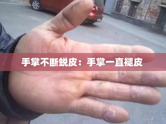 手掌不断蜕皮：手掌一直褪皮 