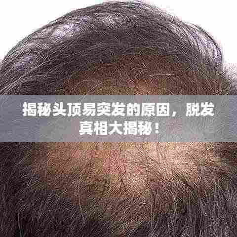 揭秘头顶易突发的原因，脱发真相大揭秘！