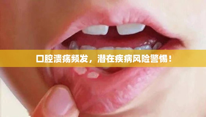 口腔溃疡频发，潜在疾病风险警惕！